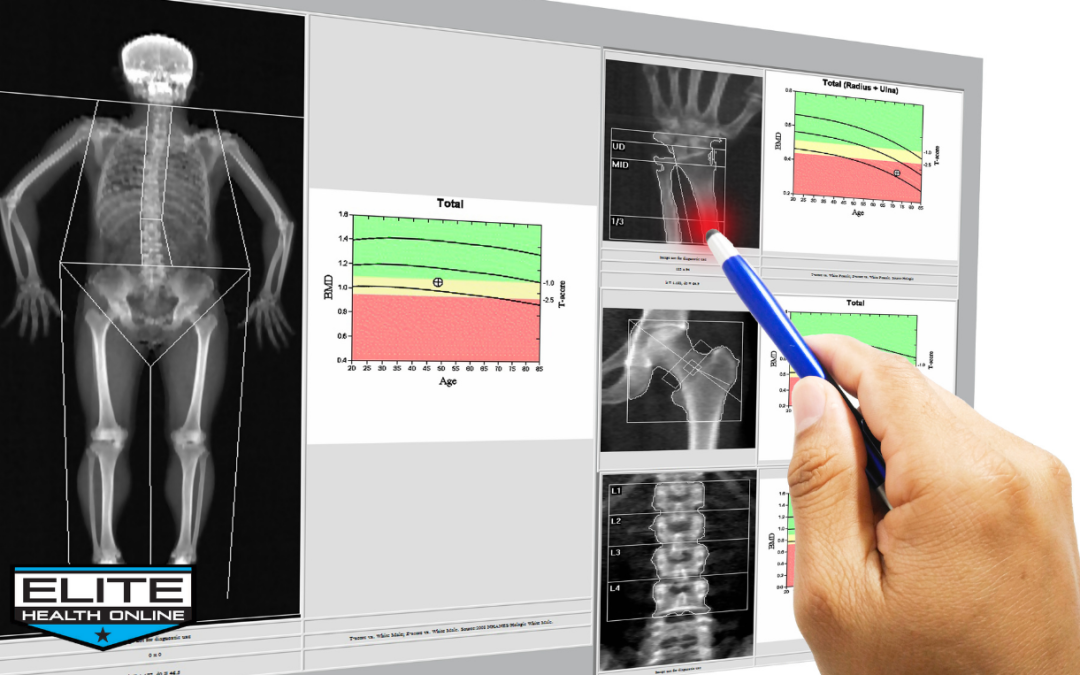 Bone Density and Testosterone