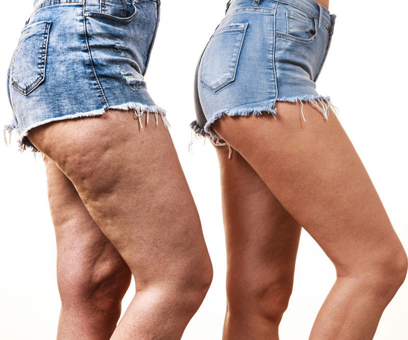Cellulite Cream